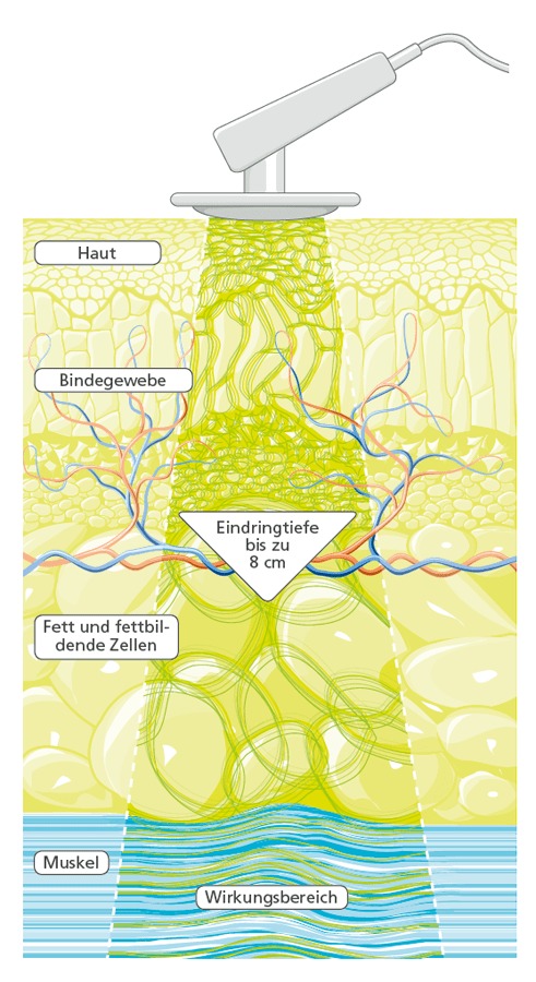 DEEP OSCILLATION PERSONAL BASIC PHYSIOMED